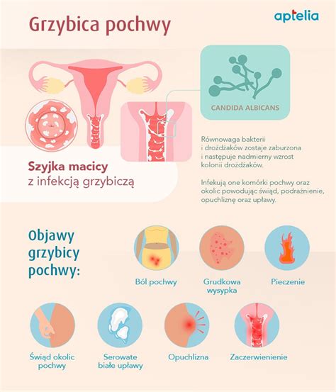 grzybica pochwy diagram